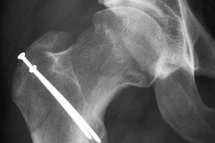 Abb. 4: Röntgenbild der rechten Hüfte nach Abtragen der Knochenanlagerungen am Schenkelhals, gleicher Patient wie Abb. 2.